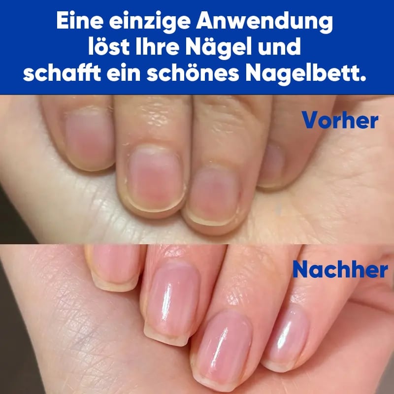 Antimykotische Nagelreparaturlösung